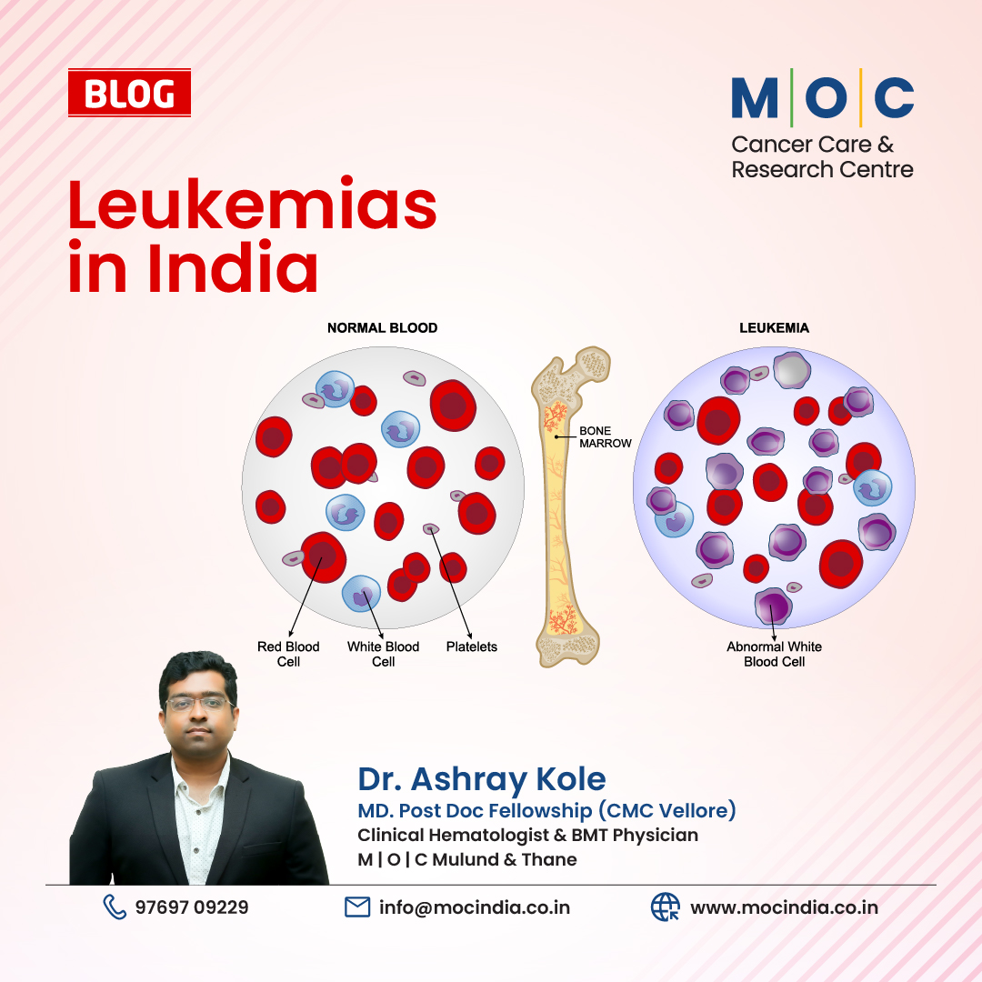 Leukemias in India- A Guide by Dr. Ashray Kole, Hemato-Oncologist & BMT Physician